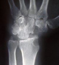 Artrodesi_4_ostarion