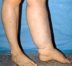 Lymphedema