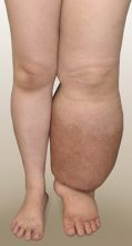 lymphedema-vs-lipedema